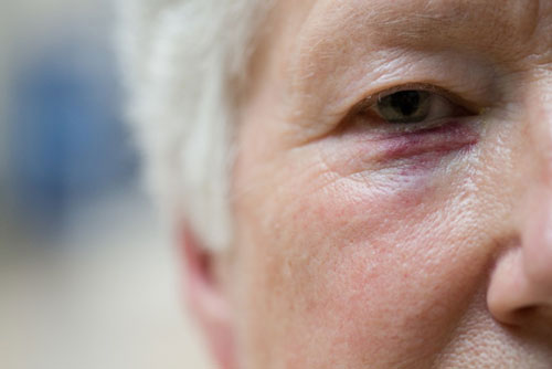 injuryimage.com, black eye, personal injury claim